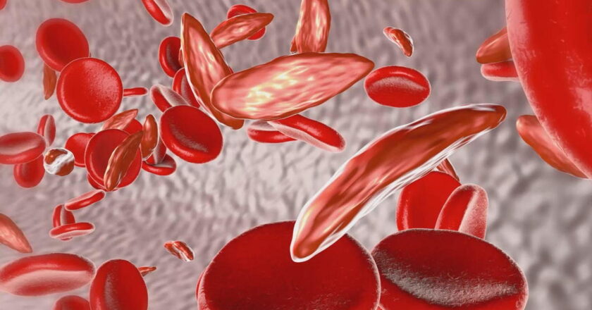 World’s first gene therapy for sickle cell and thalassemia approved in the U.K.