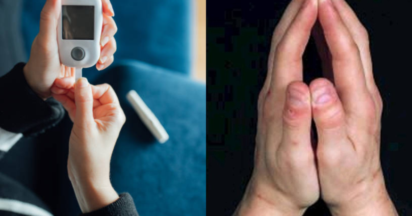 Diabetic? Fold your hands in prayer sign and check for these symptoms​